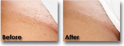 Alexandrite Laser Hair Removal - Derma Laser Clinics